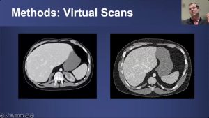 Photon-counting CT in Abdominal Imaging: Hype or Actual Utility?